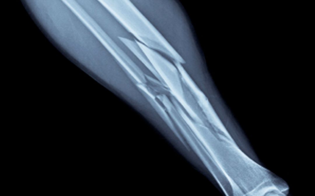 How to Handle a Broken Bone