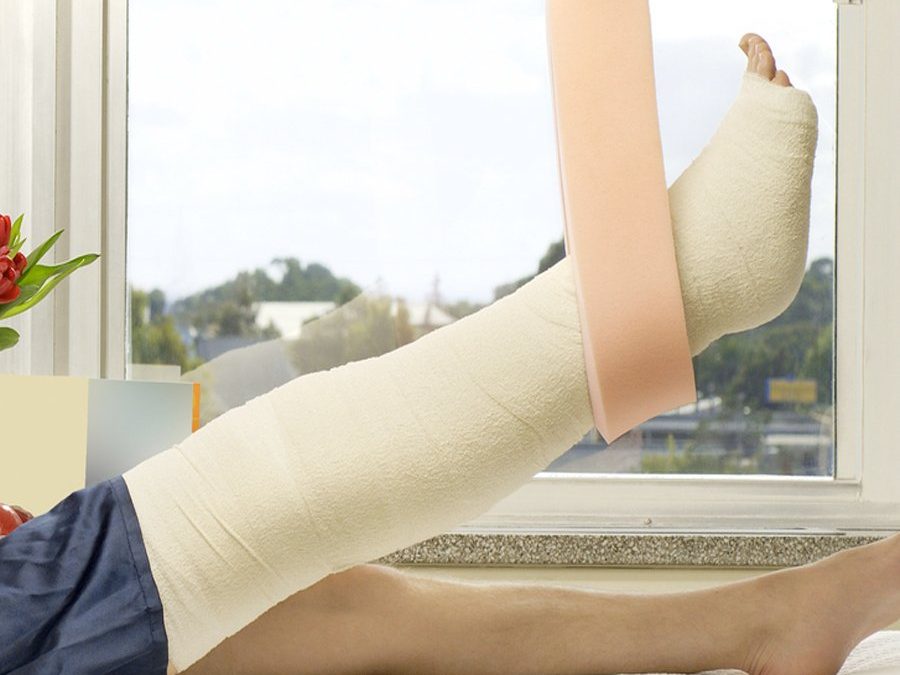 How to Recover From a Broken Leg