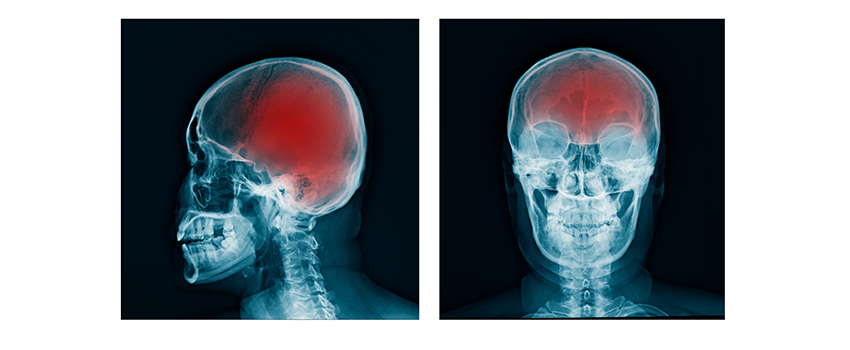How Can You Protect Yourself From a Traumatic Brain Injury?