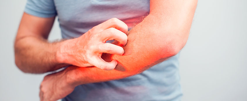 What Should I Know About Rashes?