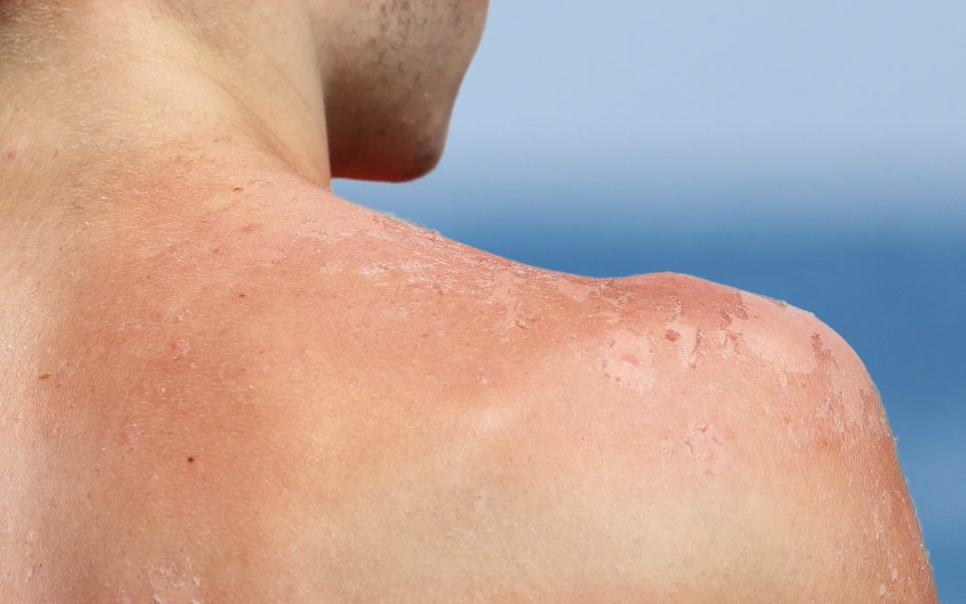 Understanding Sun Poisoning: Symptoms, Risks, and Prevention