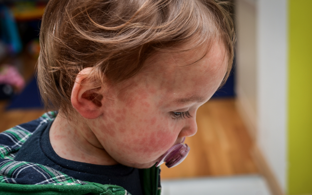 How to Protect Your Child During the Measles Outbreak