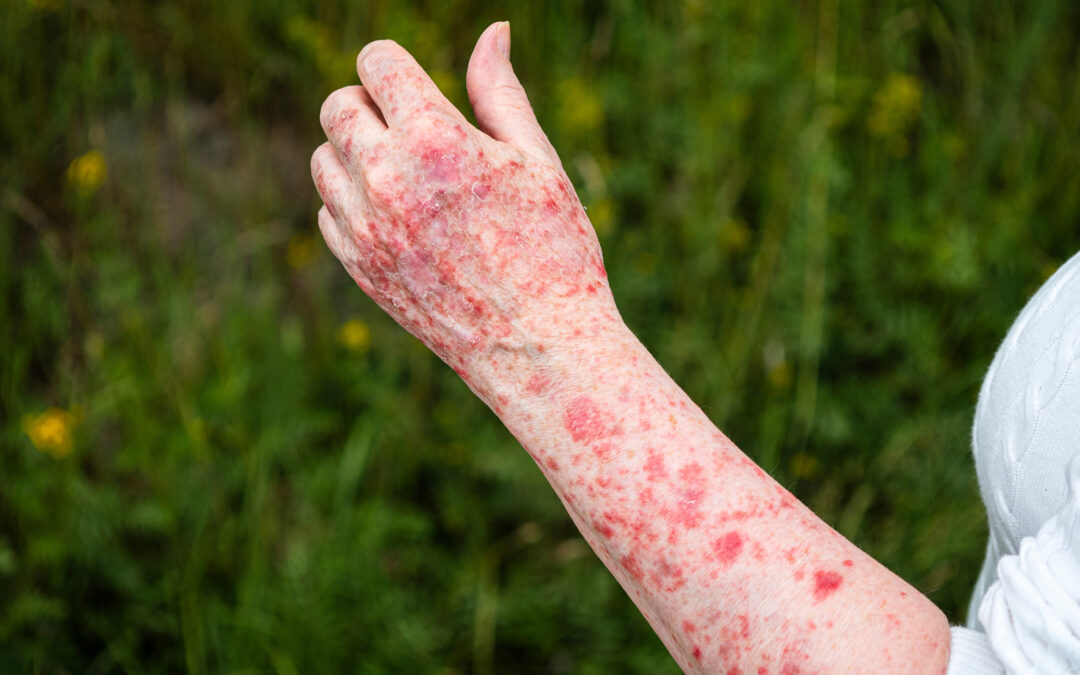 Could It Be Sun Poisoning? Signs, Symptoms, and When to Seek Treatment